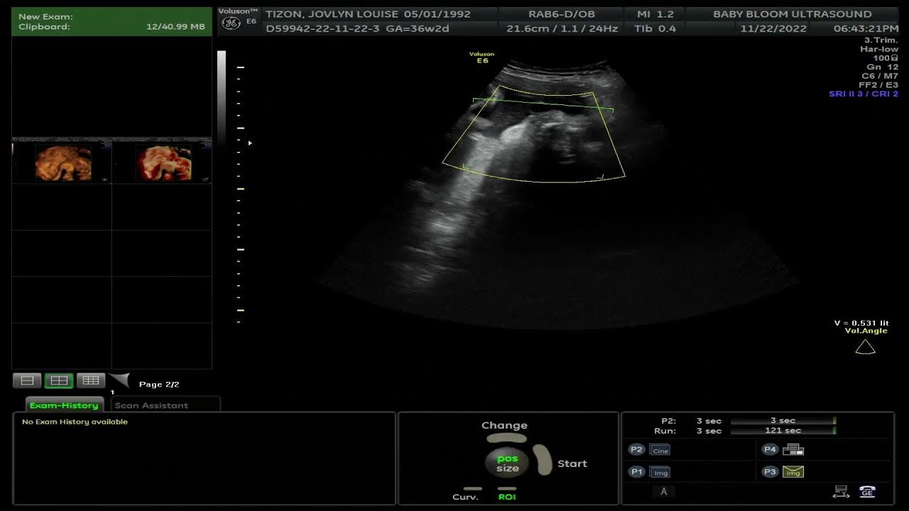 Baby bloom ultrasound live stream youtube
