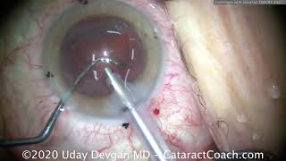 CataractCoach 1257: OSN NY challenges with Akinesia & Anesthesia