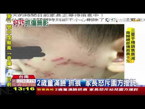 【TVBS】2歲童滿臉「抓痕」　家長怒斥園方推託
