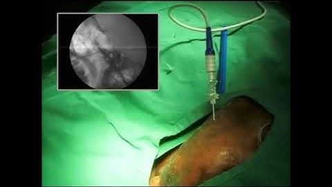 Gasserian ganglion radio frequency