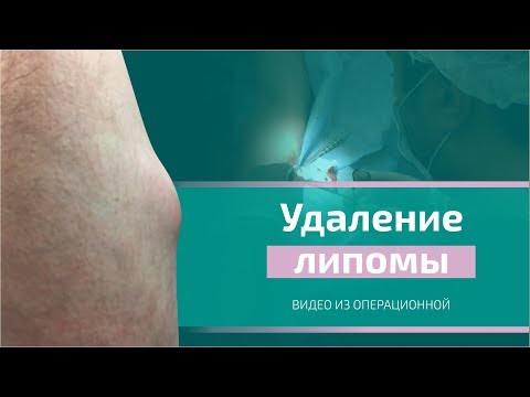 Удаление липомы на руке и ноге. Видео операции