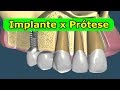 Implante Dentário x Prótese Fixa - Qual o Melhor?