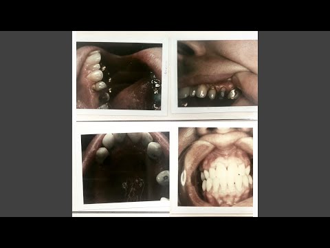 taking teeth. auf YouTube ansehen taking teeth. auf YouTube ansehen