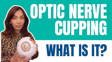 What is Optic Nerve Cupping?