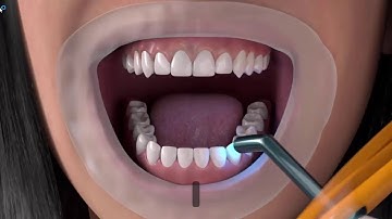 Kỹ thuật gắn Attachments trong Invisalign