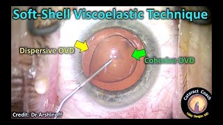 Soft-shell Viscoelastic Technique for Cataract Surgery