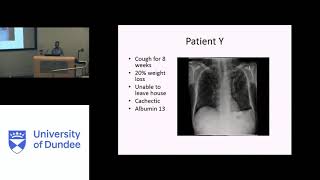 Grand Rounds 14-11-19 - Tuberculosis