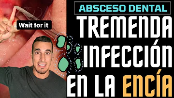 ¿Qué ocurre si no se trata un absceso gingival?