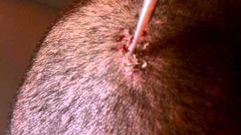 Removing staples from Bobby