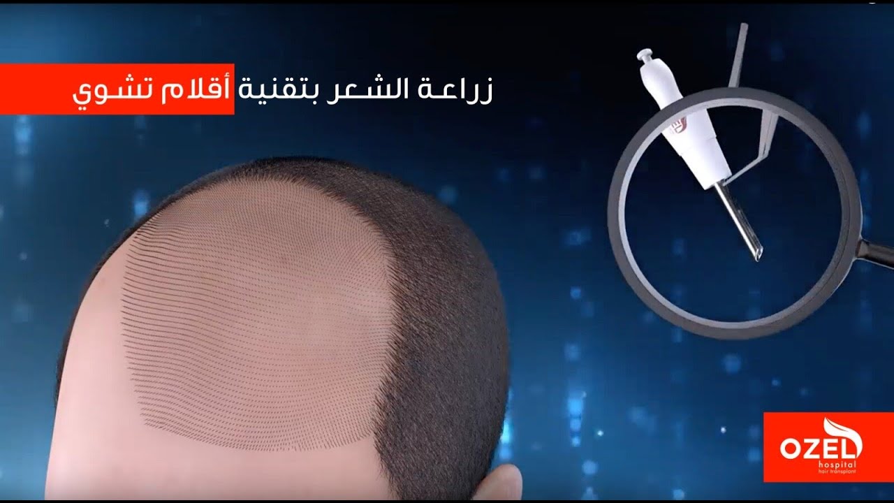 كيف تتم عملية زراعة الشعر بتقنية أقلام تشوي DHI
