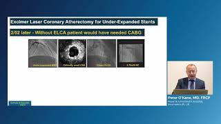 Role of laser atherectomy in coronary in stent re stenosis ISR