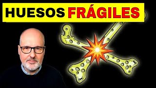 Cómo PREVENIR los HUESOS FRÁGILES (OSTEOPOROSIS) y su TRATAMIENTO