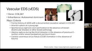 Genetic Types of EDS: Diagnosis and Testing | Clair Francomano, MD