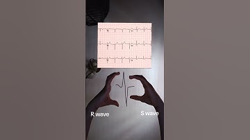 R Wave Progression in ECG