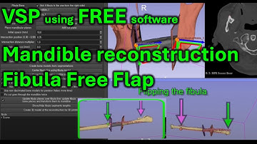 FREE software for Mandible reconstruction VSP: 3D slicer for fibula free flap tutorial