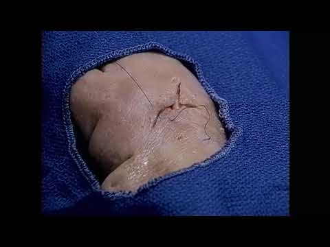 Video: Suture Separate: Cause, Diagnosi E Conseguenze