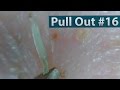 #16 Pull Out Blackheads Close up - Blackheads Removal