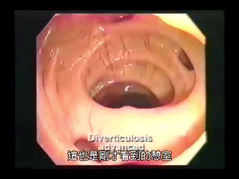 日本醫學專家拍攝的腸道內視VCR，不同飲食者，產出不同腸道