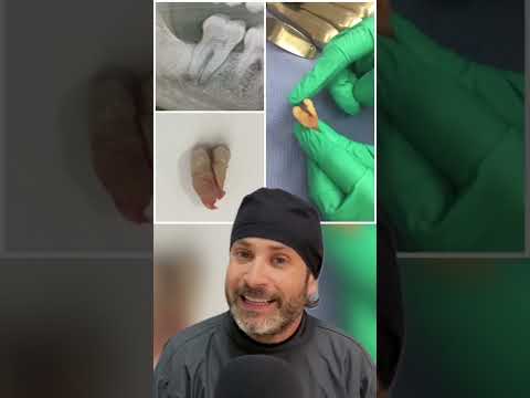 Video: ¿Pueden sanar los dientes fracturados?