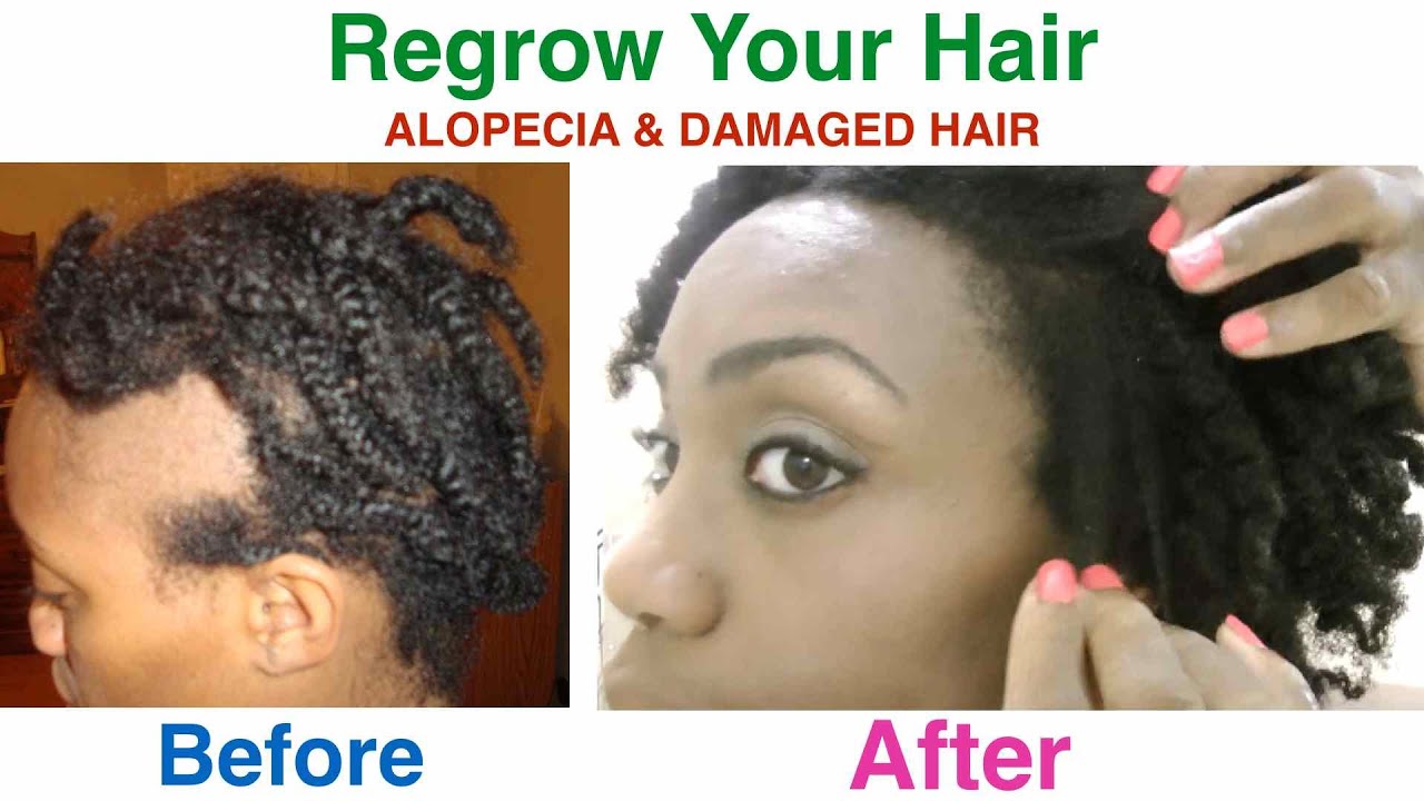 How To Regrow Your Hair Alopecia Damaged Hair YouTube