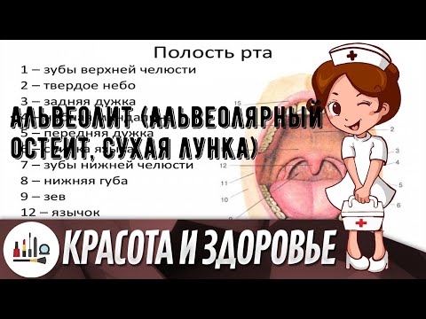 Альвеолит (Альвеолярный остеит, Сухая лунка)