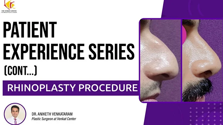 Patient Experience Series: Rhinoplasty procedure