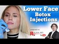 WATCH LOWER FACE BOTOX INJECTIONS // Botox for Mouth Corners