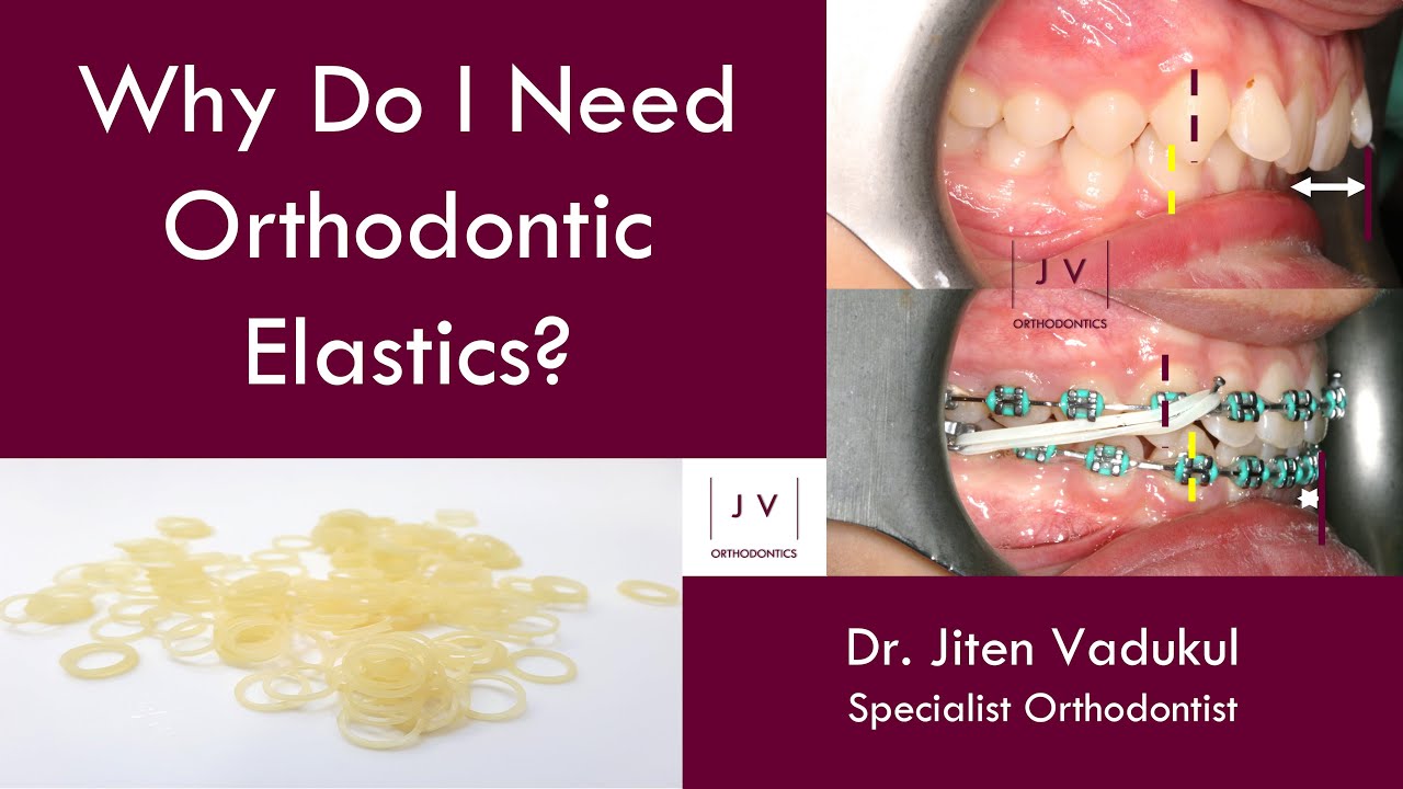 Learn More About Why Elastics Are Needed for Orthodontic Patients