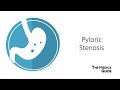 Pyloric Stenosis - A Clinical Overview for Medical Students