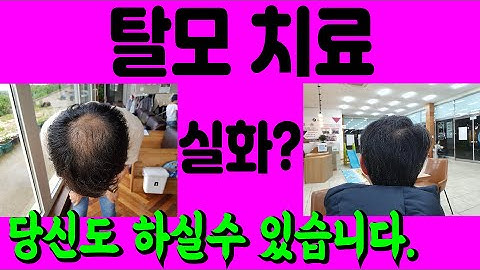 탈모치료 - Hair loss treatment 7513 탈모치료 당신도 하실수 있으십니다. 꾸준히 관리하고 치료하면 분명히 치료가 가능합니다.