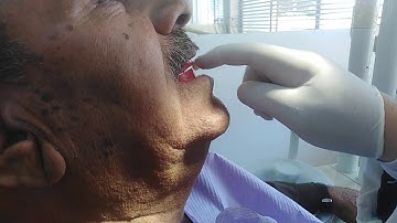 Visit 4: Try-in: Upper and lower records incorrect biting before VDO measurements