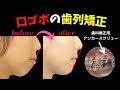 口ゴボ改善の歯列矯正を解説│アンカースクリュー│Eライン│開咬の表側矯正