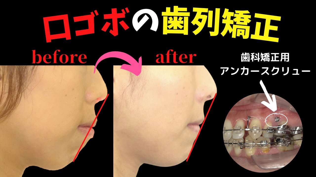 歯列矯正 口ゴボ改善の歯列矯正を解説│アンカースクリュー│Eライン│開咬の