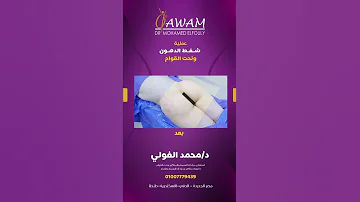 نتائج مبهرة و من أول يوم عملية شفط الدهون و نحت القوام هتديكى شكل الجسم المثالى اللى بتحلمى بيه 