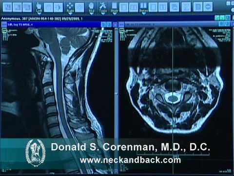 Prep for Cervical Spine MRI