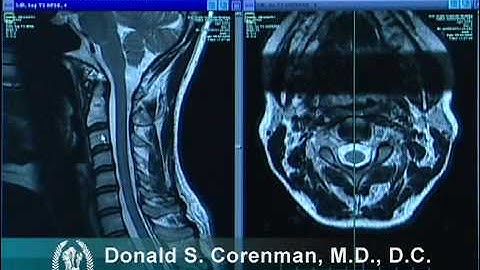 How to Read a MRI of the Normal Cervical Spine (Neck) | Colorado Spine Expert