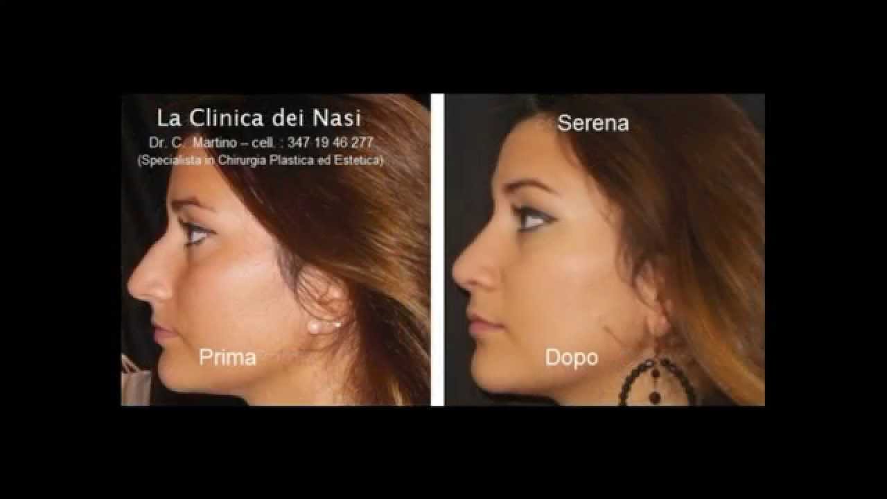 Rinoplastica Foto Prima E Dopo Serena Vicinanza Dr C Martino La Clinica Dei Nasi Youtube