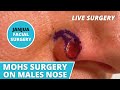 Mohs surgery on nose live surgery  dr tanveer janjua  new jersey