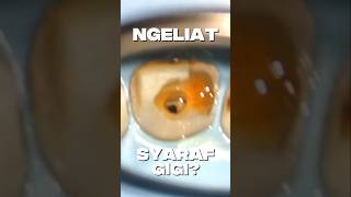 Download Lagu How to see the tooth nerve #dentist #dentalclinic #endodontics #healthyteeth MP3