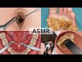 Asmr collection 2 remove large plantar warts huge navel stone salivary gland stones ear cleaning