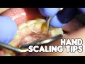 Dental Cleaning | Hand Scaling Tips