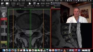 Facet Cyst in the Lumbar Spine