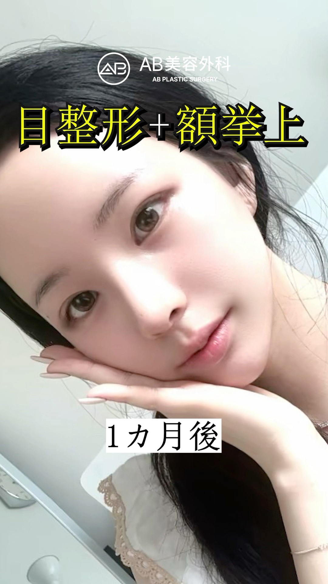 衝撃の大変身！二重＋目頭切開＋額リフトのビフォーアフター #shorts