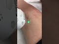 Удаление сосудов лазером
