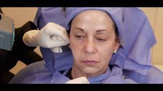 Watch Dr. Sally Booth perform a Silhouette Instalift procedure. screenshot 5