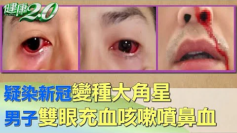 疑染新冠變種大角星 男子雙眼充血咳嗽噴鼻血 健康2.0 - 天天要聞