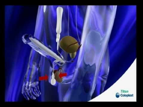 Videotutorial de uso y funcionamiento de la prótesis de pene Coloplast