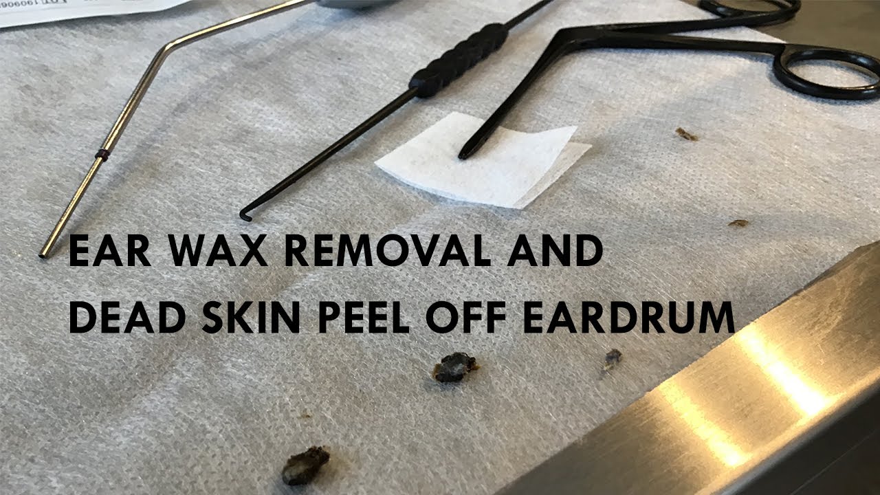 526 Ear Wax Removal & Skin Peel off Eardrum Otitis Externa Ears YouTube