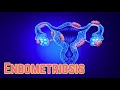 Endometriosis (Update 2018) - CRASH! Medical Review Series