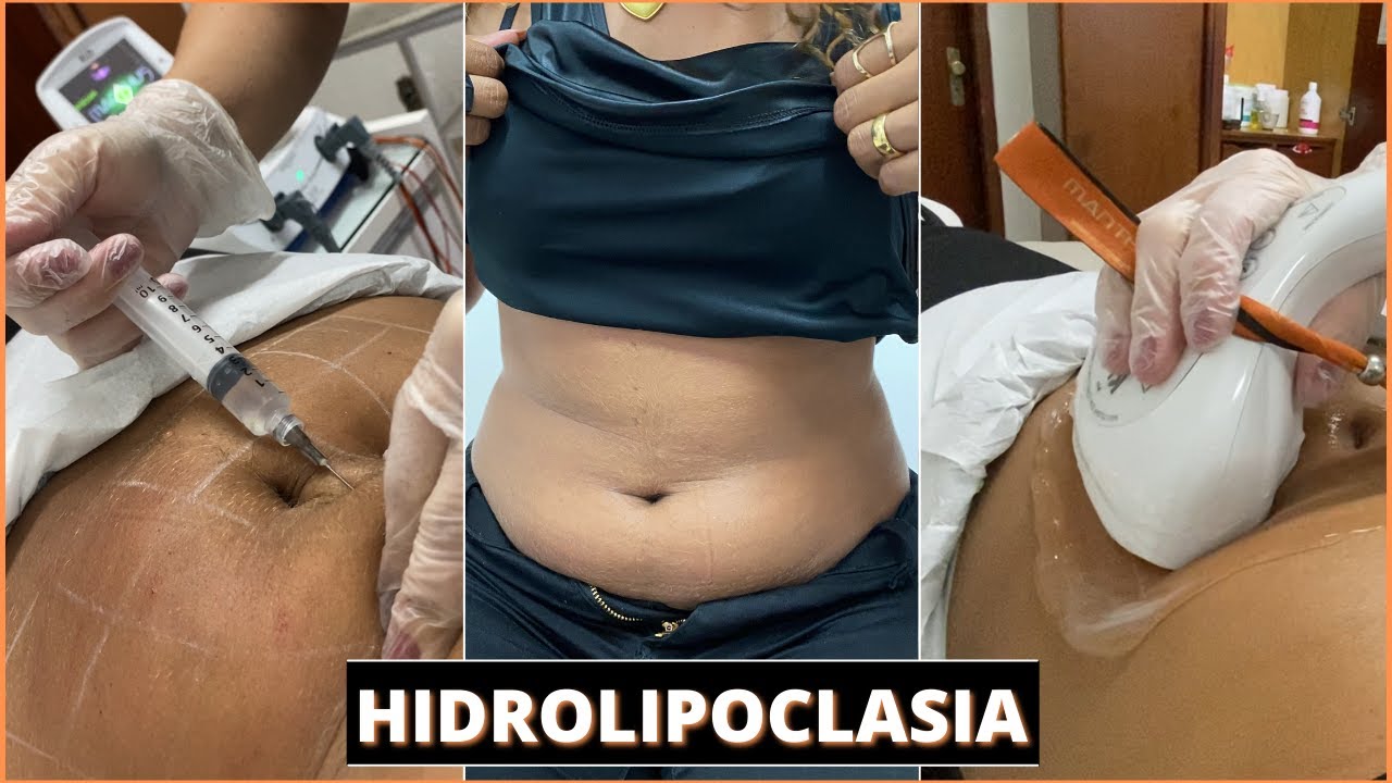 COMO É A SESSÃO DE HIDROLIPOCLASIA NÃO ASPIRATIVA - LIPO SEM CORTE(Quantas sessões? Funciona mesmo?)